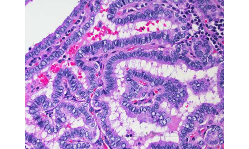 New test for thyroid cancer could prevent unnecessary surgery