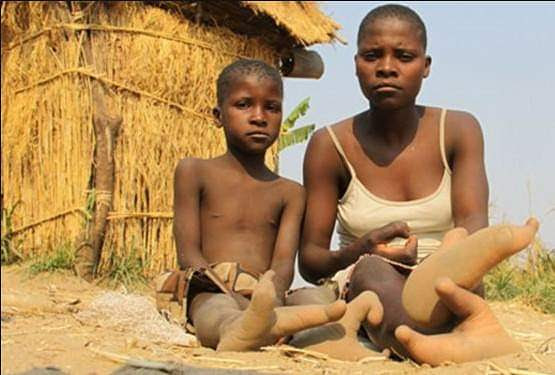 Image result for Meet strange Zimbabweâs Bantwana tribe whose people have just two toes
