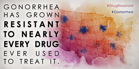 Stay Up-to-Date on Drug-resistant Gonorrhea with New CDC Resources