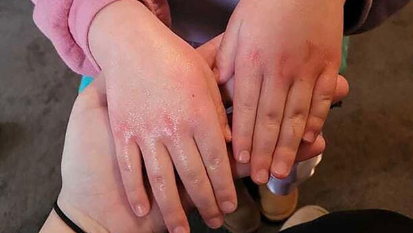 Residents Near East Palestine Reporting Unusual Rashes on Their Bodies