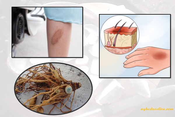 Công dụng của nghệ đen giúp làm liền sẹo khi bị bỏng