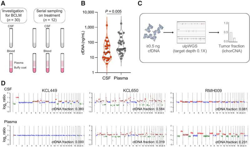 Spinal fluid analysis could speed up diagnosis of breast cancer spread