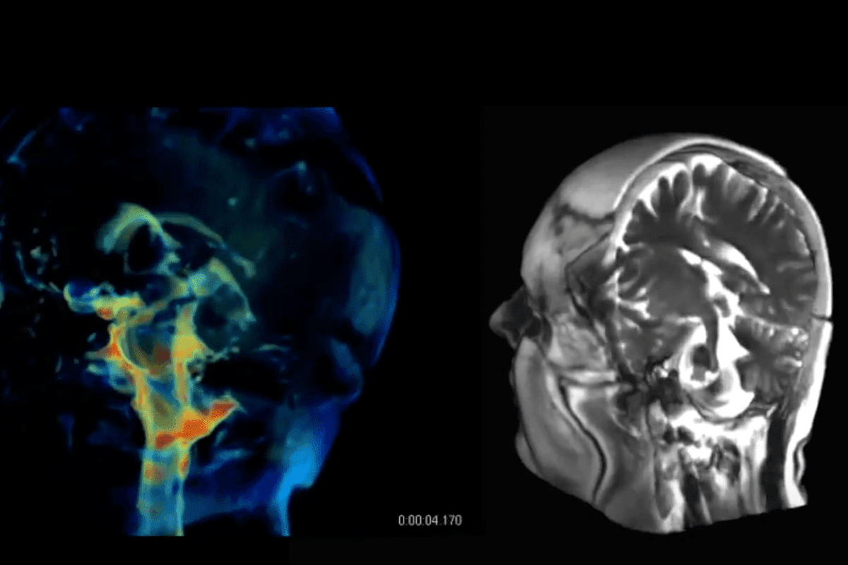 The detail in these new 3D aMRI visualizations may be able to help identify abnormalities, such as those caused by blockages of spinal fluids, which include blood and spinal fluid in the brain