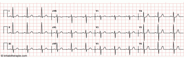 electrocardiogramme-standard