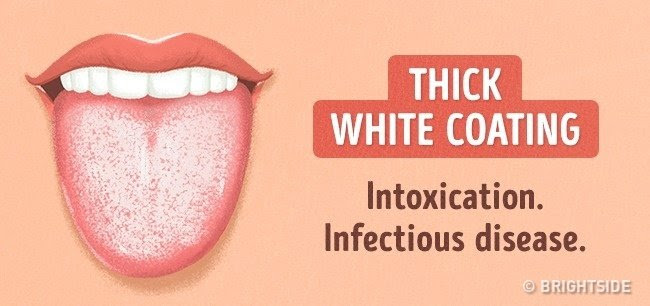 Một lớp phủ màu trắng dày: Bị nhiễm độc, bệnh nhiễm trùng