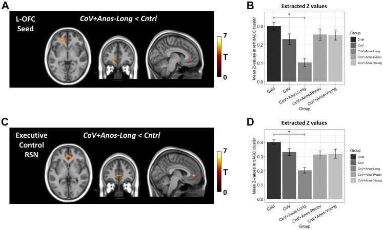 Long COVID smell loss linked to changes in the brain