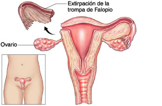 SALPINGOOFORECTOMIA (CIRUGÍA DE EXTIRPACIÓN DE OVARIOS) – Cirugía