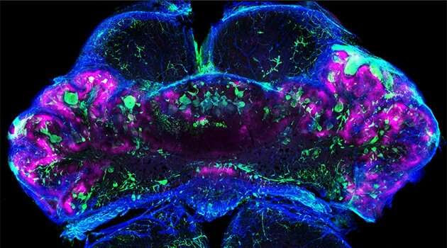 Blood clot formation in cerebral cavernous malformations