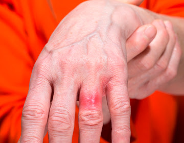 Alergia al níquel, síntomas y tratamiento de esta dermatitis de contacto