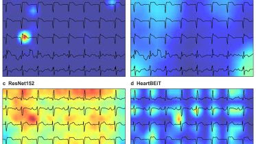 Diagnosing Heart Attacks With New AI Model