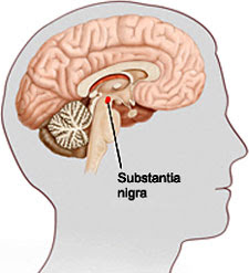 parkinson's disease