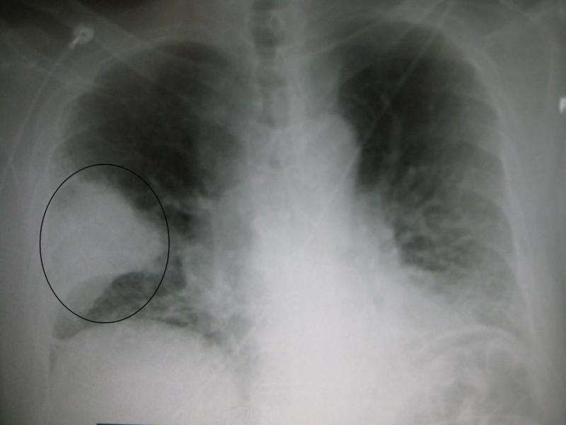 pneumonia