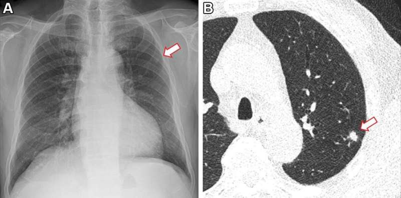 AI improves lung nodule detection on chest x-rays