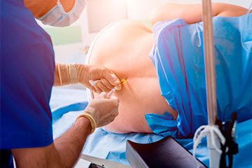 Anestesia epidural, despeja todas tus dudas sobre la analgesia para el parto