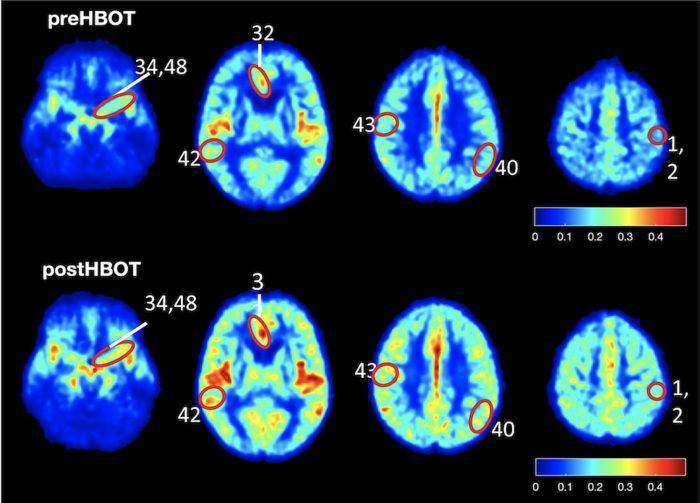 Study results show elevated blood flow and improved oxygenation in the brain of patients suffering from cognitive impairment