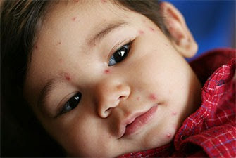 Young boy with chickenpox