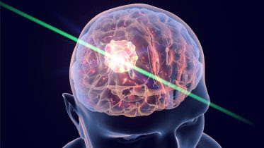 Brain Cancer Laser Treatment