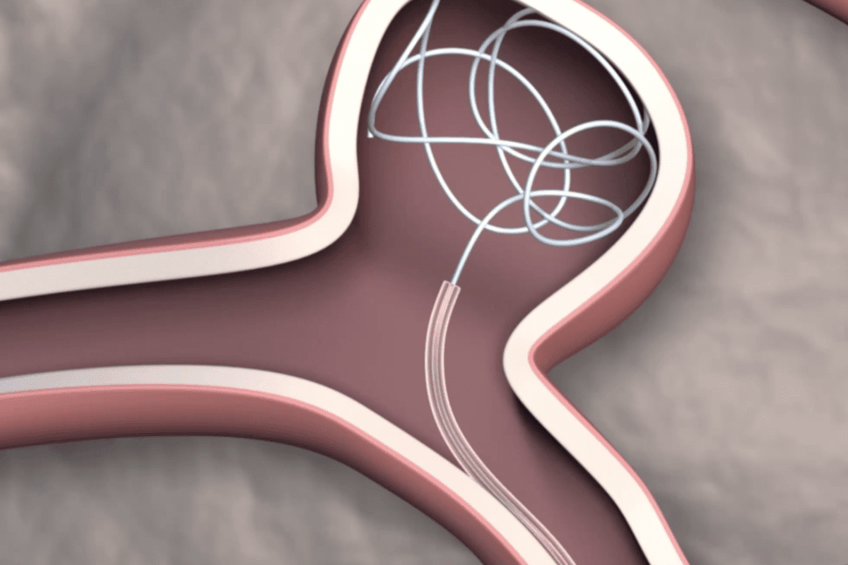 Graphic of a newly developed steerable catheter depositing platinum coils to treat an aneurysm