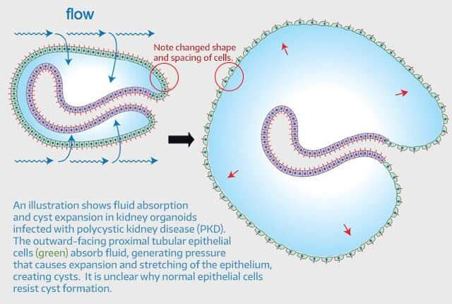 Study illuminates sugar's role in common kidney disease