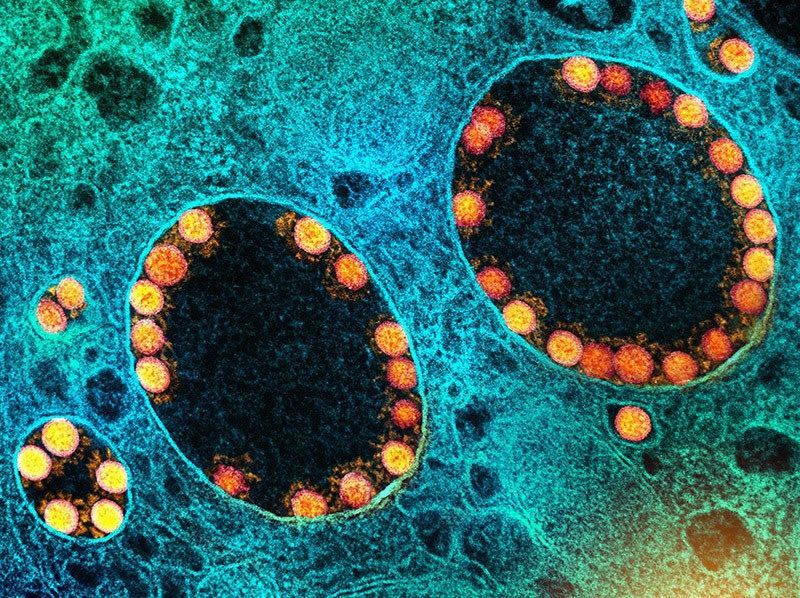 Transmission electron micrograph of SARS-CoV-2 virus particles (gold) within an infected nasal Olfactory Epithelial Cell.