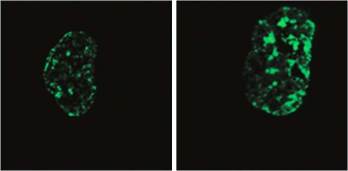 New target identified for treatment of premature aging disease