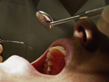 لقاح لعلاج تسوس الأسنان
