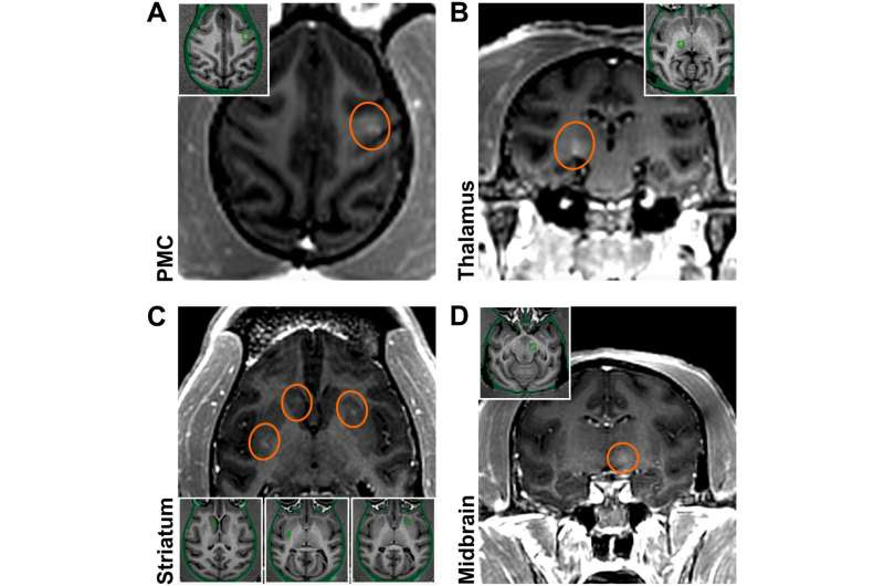 Sneaking past the blood-brain barrier to usher in the age of gene therapy for neurodegenerative disease