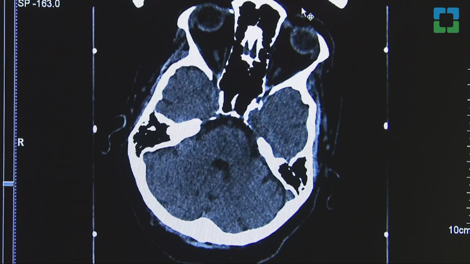 Cleveland Clinic trial provides potential hope for stroke patients dealing with paralysis