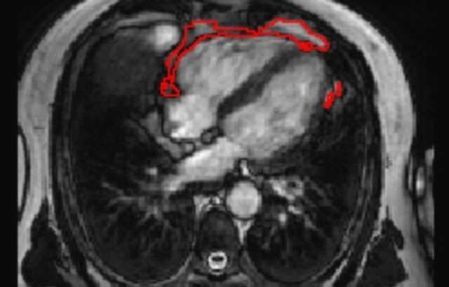 AI predicts diabetes risk by measuring fat around the heart