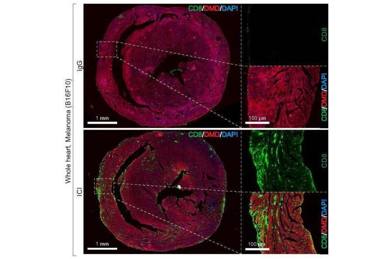 Hormone therapy could lower risk of immunotherapy-associated myocarditis in women