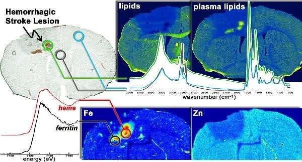 Cutting-edge imaging yields new insights into stroke